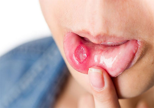 Viêm khoang miệng: Nguyên nhân, triệu chứng, Thuốc trị
