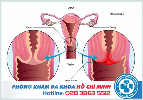 Viêm lộ tuyến cổ tử cung là gì