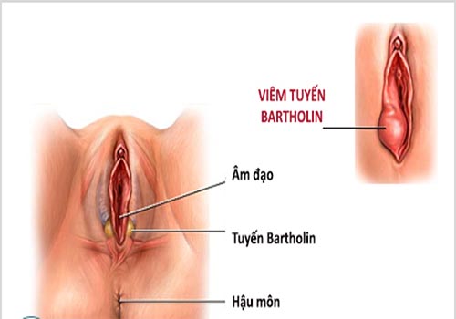 Viêm tuyến bartholin tái phát và cách trị dứt điểm