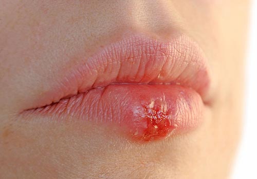 Zona thần kinh ở miệng: Tác hại và Cách điều trị tốt nhất